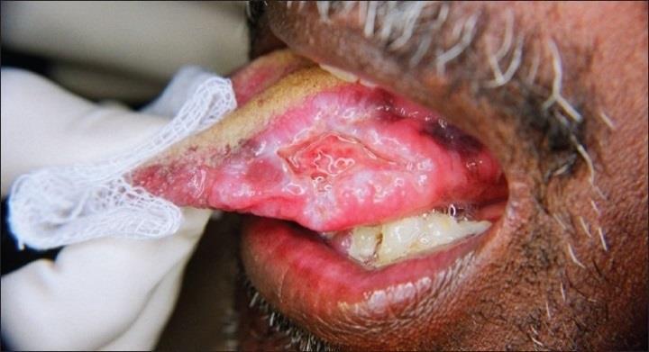 Slika 11. Ulcus na lateralnoj strani jezika. Preuzeto iz (30) Terapija: Blagi do umjereni sluĉajevi histoplazmoze mogu se lijeĉiti ketokonazolom ili itrakonazolom od 6 do 12 mjeseci.