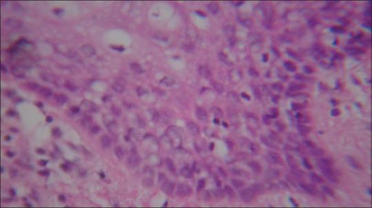 Slika 13. Histopatološke fotografije kćeri i majke pokazale su gusto rasporeċene kolagene snopove, brojne fibroblaste i vezivno tkivo.