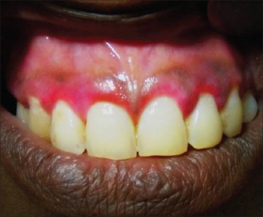 Slika 17. Eritematozna labijalna gingiva u odnosu na maksilarne sjekutiće. Preuzeto iz (47) Bulozni pemfigoid se uglavnom pojavljuje kod odraslih osoba starijih od 60 godina.
