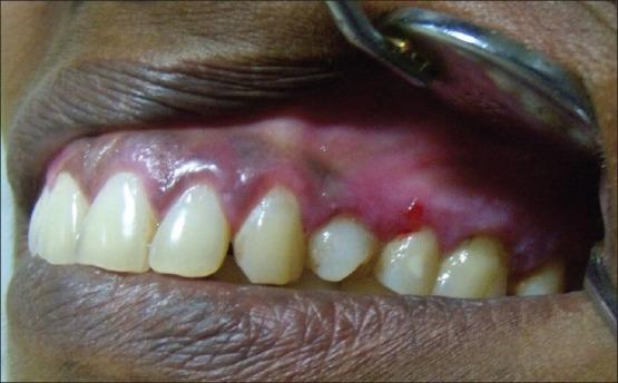 Slika 18. Krv je obojila intaktnu bulu kod deskvamativnog gingivitisa u u odnosu na straţnje zube.