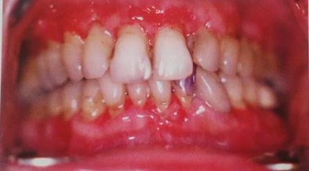 Ispoljava se u tri kliniĉke forme: blagoj umjerenoj i jasno izraţenoj Blaga forma hroniĉnog deskvamativnog gingivitisa se najĉešće otkriva sluĉajnim stomatološkim pregledom.