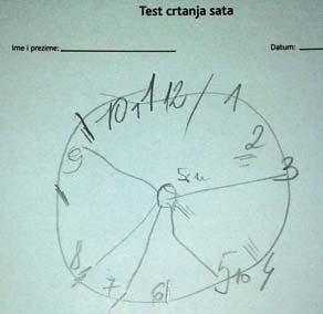 Slika 2. Slika 1. CDT - Bolesnica stara 64 god., sa dijagnozom BKP Slika 2 i 3 CDT - Bolesnik, star 71 god.,sa dijagnozom AB. Slika 3.