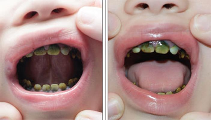 Da bismo uspješno proveli izbjeljivanje zubi potrebno je prvo dijagnosticirati uzrok obojenja zubi jer se ovisno o uzroku koriste određene tehnike izbjeljivanja, različite su koncentracije i vrste
