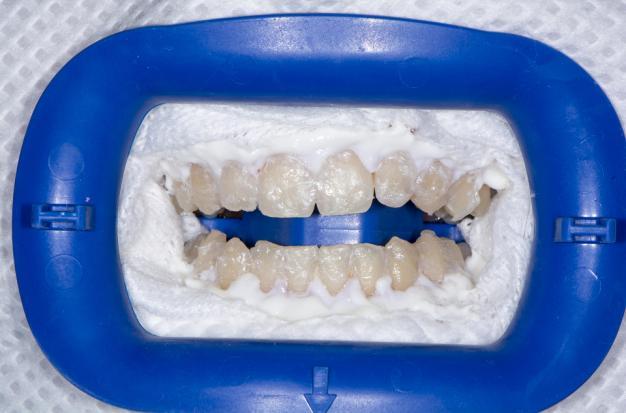 S obzirom na vitalitet zubi razlikujemo postupke izbjeljivanja vitalnih i postupke izbjeljivanja avitalnih zubi. 5.1.