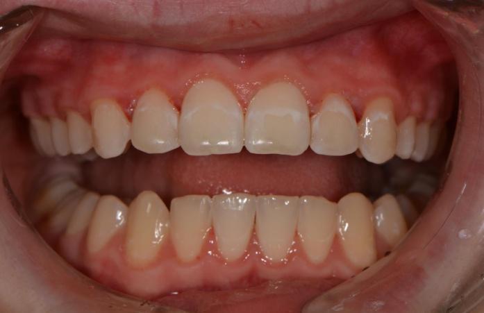 Vanjska resorpcija korijena nakon izbjeljivanja zubi.