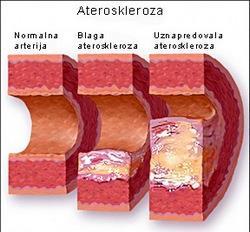 Ateroskleroza Oštećenje arterija obilježeno smanjenjem lumena krvnih žila zbog lokalnog zadebljanja unutarnjeg sloja stjenke žile koje se zove ATEROM ili PLAK.