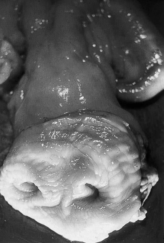 Slika 6. Uterus delphys sa dvostrukim ušćem cerviksa (NOAKES i sur., 2009.). 3.1.10. Dvostruki maternični grljak (cervix duplex) Dvostruki cerviks nalazi se nepotpuni ili potpuni.