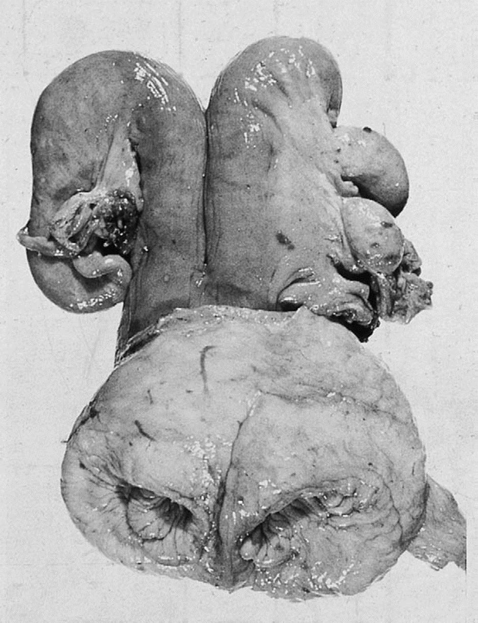 Slika7. Uterus didelphys sa dva potpuno odvojena cervikalna kanala (NOAKES i sur., 2009.). 3.1.11.