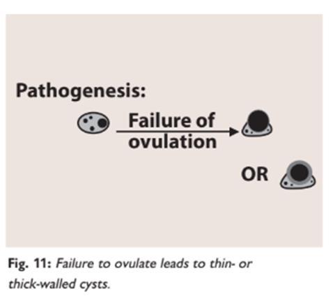 Patogeneza cistične bolesti jajnika, pojednostavljeno je da folikul ne ovulira nego nastavi rasti i postane cističan. (Slika 20.). Slika 20. Greška u ovulaciji (McCRONE, 2009.). 3.4.5.1.