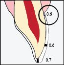 Shema br. 4- Preparacija za ljuspicu Preparacija za prednju krunicu - Reducirati jednakomjerno i anatomski poštujući navedene minimalne vrijednosti debljine.