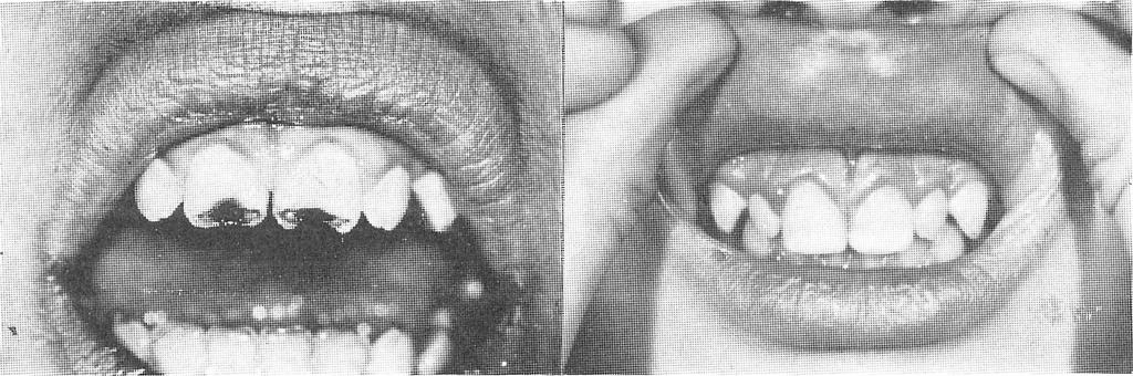 Do punog izražaja dolazi kemijsko vezivanje palakava za dentin, pri rekon strukciji onih zubi, u koj«ih je provedena amputacija ili ekstirpacija pulpe pa se može koristiti manji ili veći dio