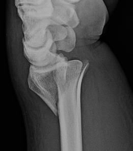 8. DIJAGNOSTIKA Nakon uzete anamneze i detaljnog pregleda često možemo posumnjati na ovu ozljedu te je sljedeći korak RTG snimka ručnog zgloba u dvije projekcije, AP i latero-lateralna (Slika 3, 4)