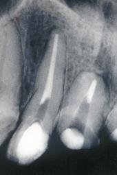 Radiografska snimka zuba 22 i 23 - vide se tragovi materijala za punjenje kanala zaostali na zidovima pri preparaciji intraradikularnoga leæiπta nadogradnje Figure 4b.