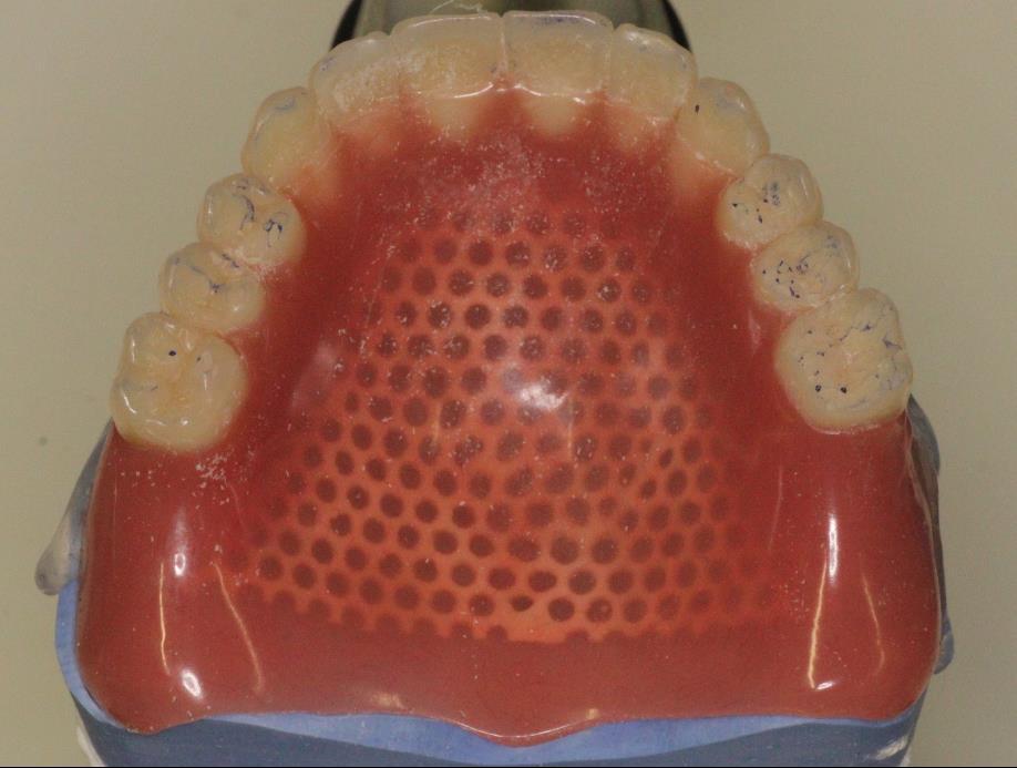 uspostavljaju se zubni dodiri na distalnim kosinama očnjaka i između svih stražnjih, dok su prednji zubi izvan dodira za 100 do 200 μm.