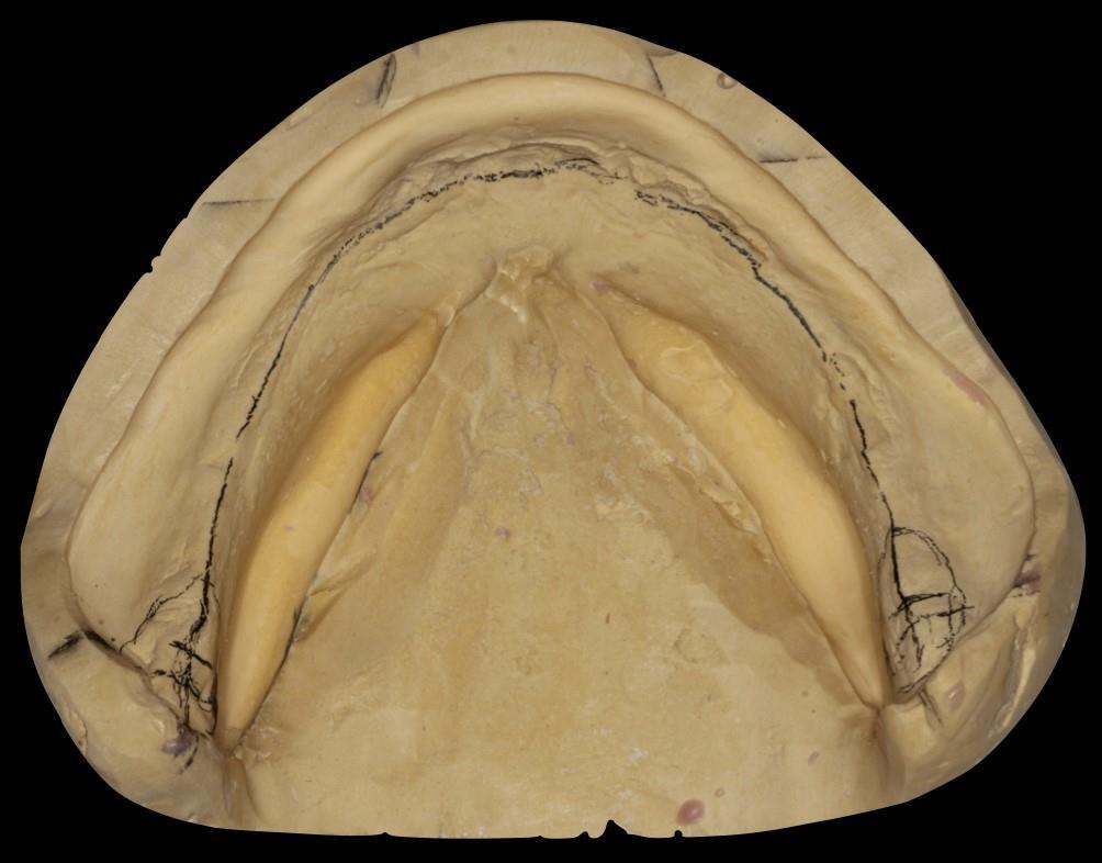 Na donjem radnom modelu ucrtava se prednja središnja grebenska linija. O veličini resorpcije bezubog grebena ovisi za koliko se donji prednji zubi postavljaju ispred te linije.