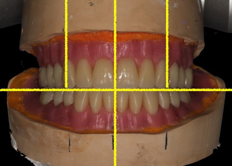 Ekstraoralna kontrola postave zuba podrazumijeva provjeru položaja zuba prema oznakama na radnim modelima (Slika 21.