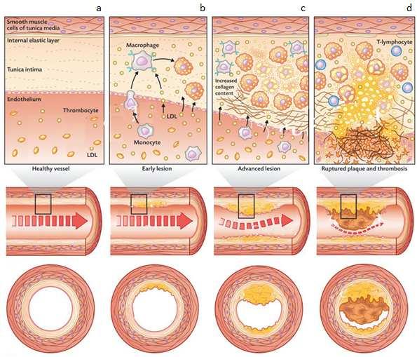 Slika 3. Faze u razvoju aterosklerotske lezije. Preuzeto sa: https://emilyspiersbiology.weebly.com/alevel-biology-blog/atherosclerosis, 11. 6. 2018.