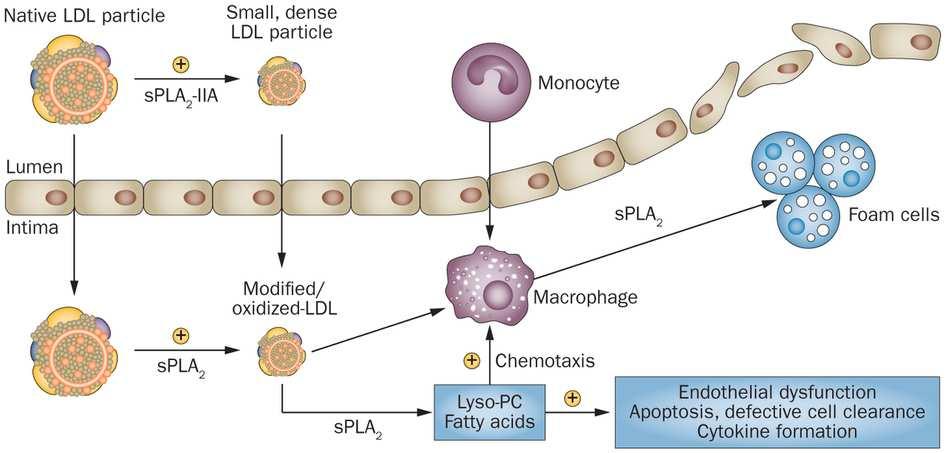 Slika 10. Proaterogena svojstva malih, gustih LDL čestica. Preuzeto iz: O'Donoghue ML. Acute coronary syndromes: Targeting inflammation what has the VISTA-16 trial taught us? Nat Rev Cardiol.