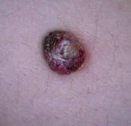 Нодуларни меланом (енг. Nodular melanoma, NM)- присутан је најчешће у пределу трупа, врата и главе. Карактерише га вертикални раст од почетка настанка болести.