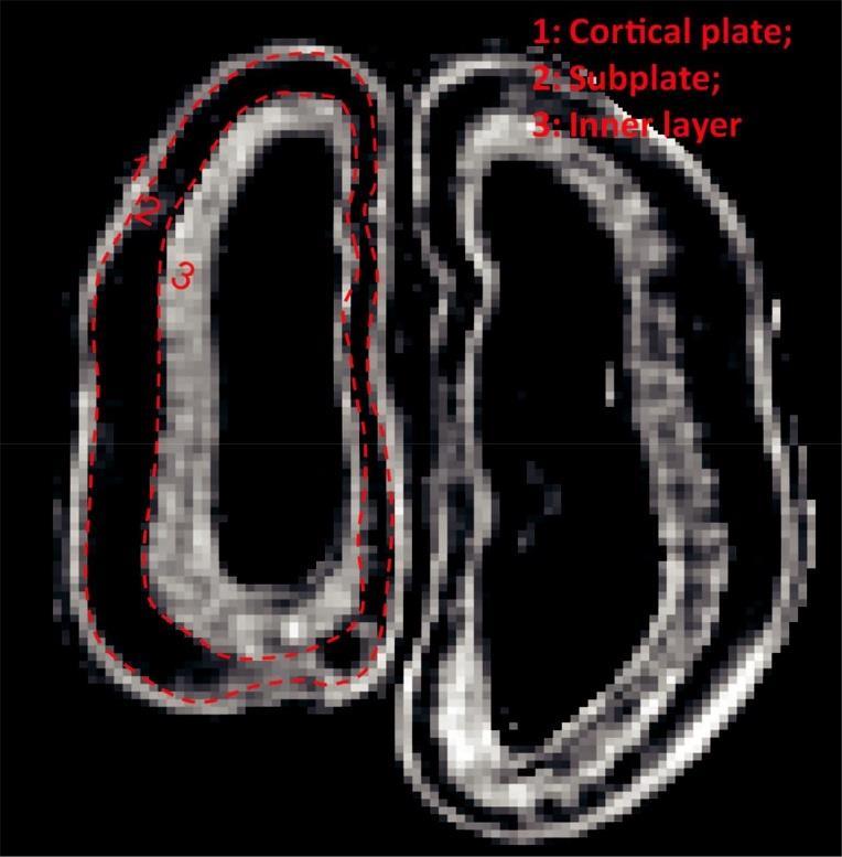 Slika 3. Difuzijskom traktografskom metodom oslikavanja mozga u 17. GT-u moguće je identificirati tri sloja različite FA vrijednosti.