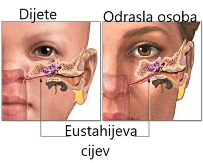 javiti ako je grlo nateknuto i spriječi protok zraka u Eustahijevu cijev. Barotrauma ima simptome kao što su bol u ušima, nelagoda i smanjeni ili prigušeni sluh.