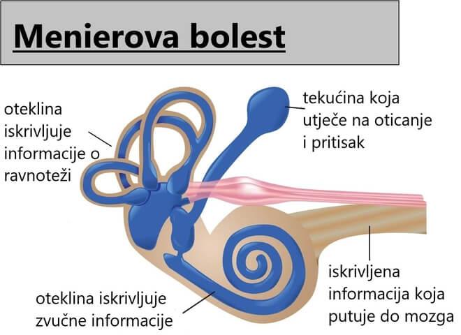 Uzrok Menierove bolesti nije točno određen, ali najvjerojatnije je to abnormalan volumen ili sastav tekućine u unutarnjem uhu.