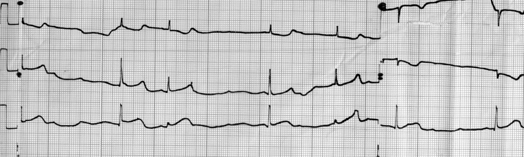 EKG na prijemu: