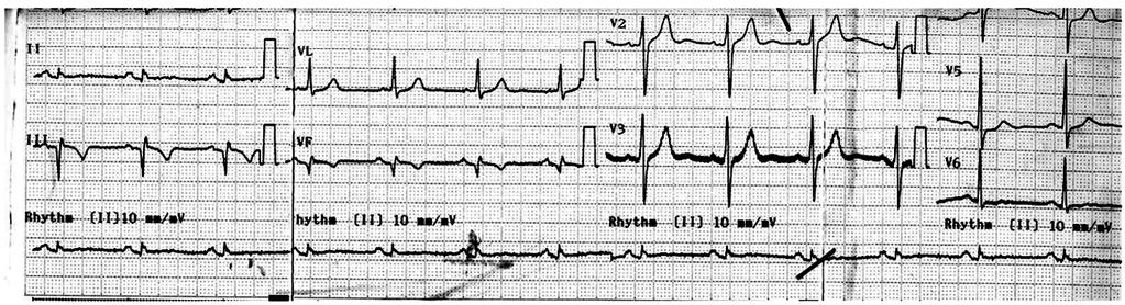 Primarna PCI EKG posle ZAKLJUČAK Pored jasnih indikacija za primenu privremenog pejsmejkera u terapiji bradikardnih poremećaja srčanog ritma, primena primarnog PCI u terapiji akutnog infarkta