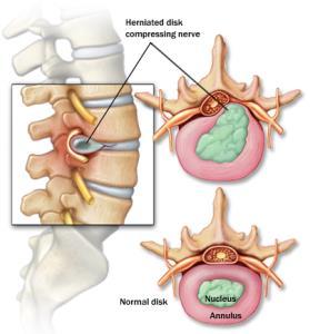 Slika 4. Pritisak herniranog diska na živac Razlikuju se tri vrste ruptura anulusa fibrozusa: koncentrična, radijalna i poprečna. Koncentrične i poprečne nemaju kliničkog značenja.