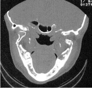 postaviti pravilna dijagnoza, te zbog same cijene snimka. CT snimke se koriste ukoliko imamo kompleksne povrede mandibule,udružene prelome i slično (16).