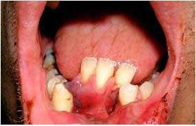 10. DENTOALVEOLARNI PRIJELOMI Dentoalveolani prelomi su definisani kao prelomi gdje imamo avulziju, subluksaciju ili frakturu zuba udruženu sa frakturom alveolarnog grebena.