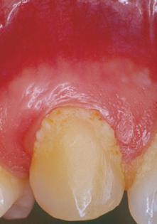 1.5 Etiologija i patogeneza parodontopatija Parodontalna bolest nastaje kao patološka reakcija parodontalnih tkiva na vanjsku (lokalnu) iritaciju, a odgovor parodontalnih tkiva modificiran je
