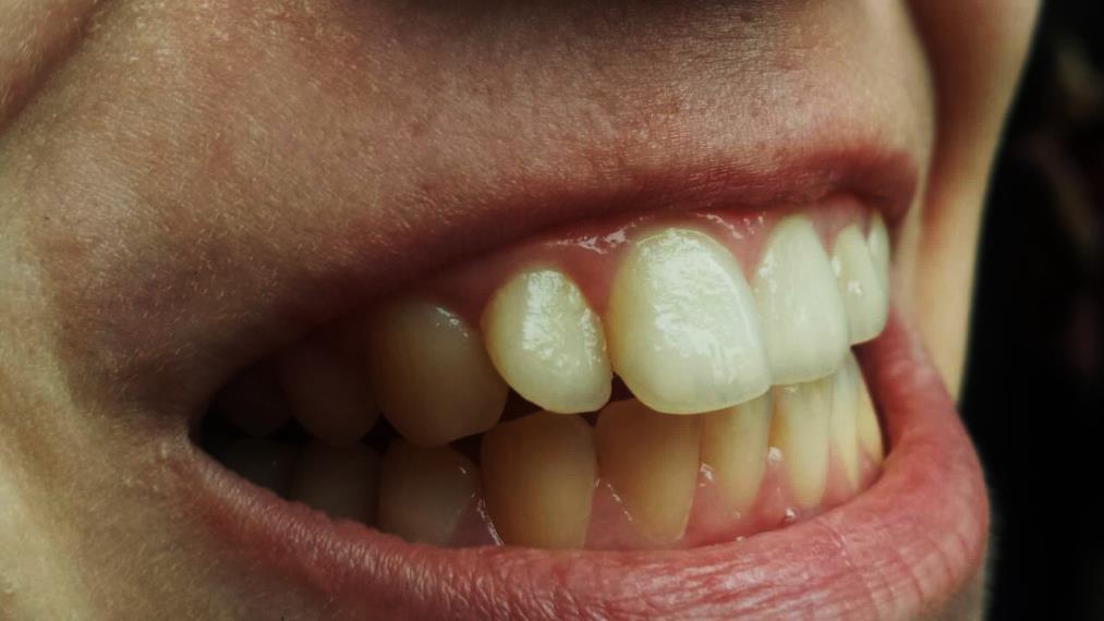 3.1 Pelikula (opna) Prva faza u nastanku dentalnog plaka/biofilma je stvaranje pelikule. (7) Ako se zubna površina ispolira tako da na njoj ne bude nikakvih naslaga, u vremenu od 15min.
