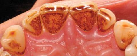3.5 Pigmentacije Pigmentacije su obojene akumulacije na zubnim površinama, koje pacijentu stvaraju estetske probleme. Dijele se na vanjske i unutrašnje.