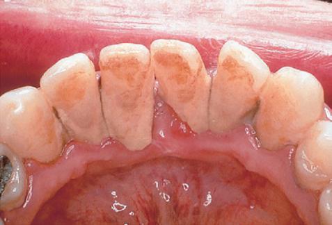 3.6 Zubni kamenac Zubni kamenac ili calculus je adherentna masa na površini zuba, koja je zapravo kalcificirani plak.