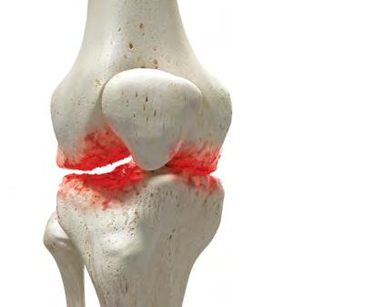 liječenje osteoartritisa koljena hladnoće