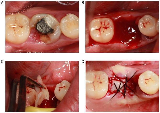 Slika 7. Postupak minimalno invazivne ekstrakcije i primjena PRF-a. (A) Klinički pregled zuba predviđenog za ekstrakciju. (B) Postekstrakciona alveola.