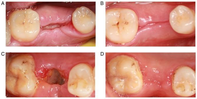Slika 8. Lokalizovano cijeljenje mehkog tkiva nakon ekstrakcije zuba.
