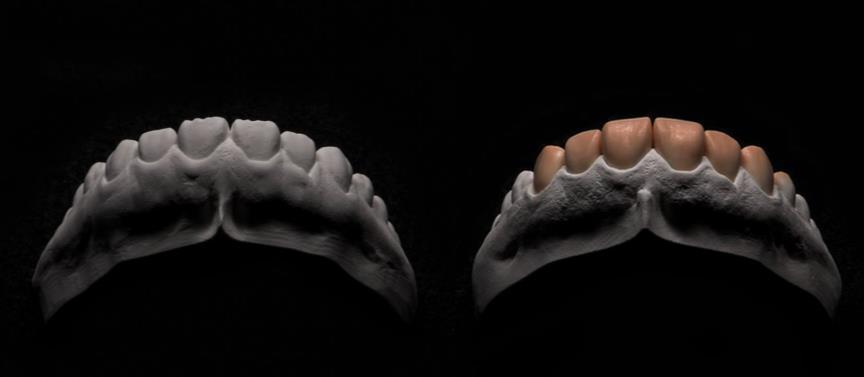 c) Preparacija vestibularne stijenke zuba sa skraćenjem oko 2 mm sa stepenicom na palatinalnoj plohi najkompliciranija je. Indicirana je kada se želi izbjeći dodir antagonista i ljuske.