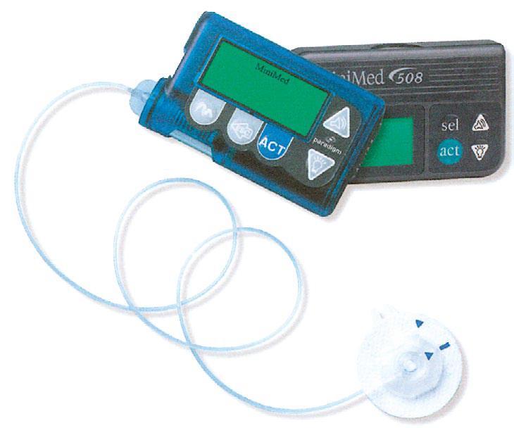 Slika 5: Inzulinska pumpa Izvor: Prašek M., Jakir A. Inzulinske pumpe i kontinuirano mjerenje glukoze. Medix 2009 15;80/81:170.