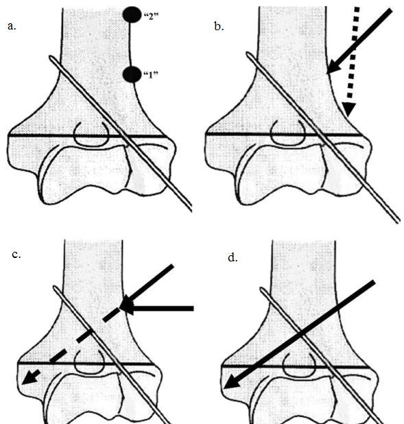 Tehnika po Dorganu podrazumeva perkutanu fiksaciju preloma humerusa ukrštenom konfiguracijom Kiršnerovih igala, pri čemu se obe Kiršnerove igle postavljaju sa lateralne strane.