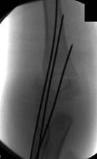 Posle stabilizacije suprakondilarnog preloma Kiršnerovim iglama, sledi gipsana imobilizacija povreďene ruke nadlaktnom gipsanom longetom, pri čemu je lakat u poloţaju fleksije od 60 do 90 stepeni, a