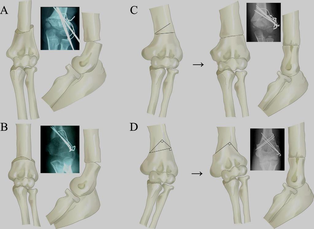 kontroverzni stavovi o vrednosti korektivnih osteotomija distalnog humerusa u cilju lečenja kubitus varus deformiteta.