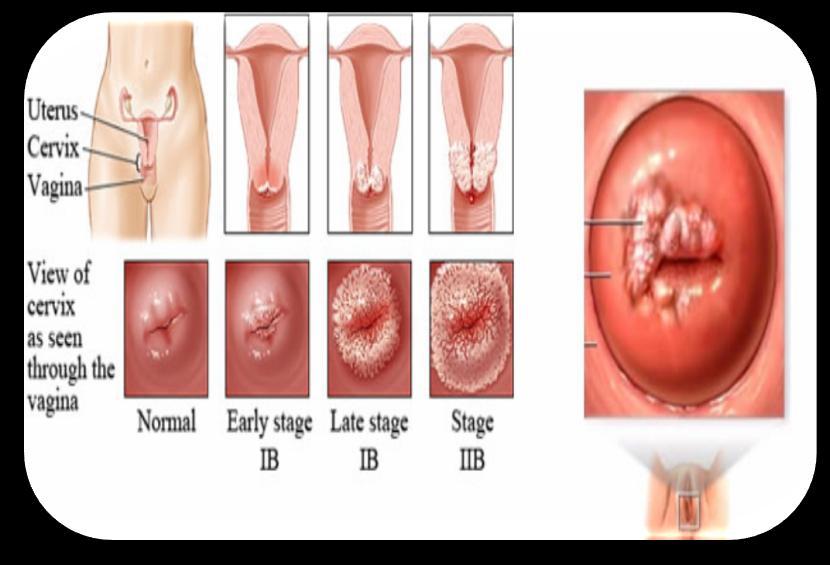 Шта је рак грлића материце? Рак грлића материце је злоћудни тумор који настаје на грлићу материце.грлић материце је део материце који је окренут према вагини ( сл.2).