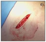 Врсте акутних рана: а) огуљена кожа, б) хируршки рез и в) одеротина