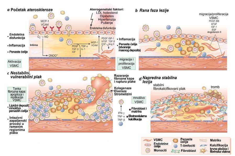 1.Uvod VSMC, makrofaga i limfocita; 2) formiranje vezivnog tkivnog matriksa sastavljenog od elastičnih, kolagenih i proteoglikanskih vlakana i 3) akumulacije lipida, najviše slobodnog i