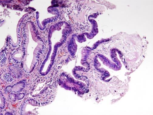 Displastične promjene površnog i žljezdanog epitela sluznice žučne kese (originalna slika; H&E, x100) Displastične promjene mogu da alteriraju u karcinom in situ, čije ćelije imaju citološka