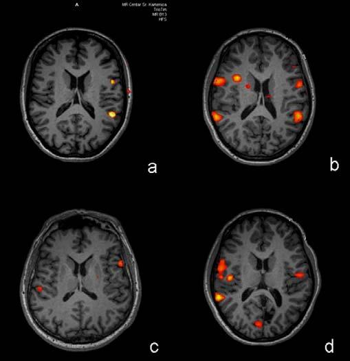 Br. 4 Funkcionalna MR u proceni rizika neurohirur{ke resekcije 33 tumora mozga Operativni zahvat na~injen je u 11 ispitanika, u 3 ispitanika indikovano je dalje pra}enje toka bolesti, dok za 3