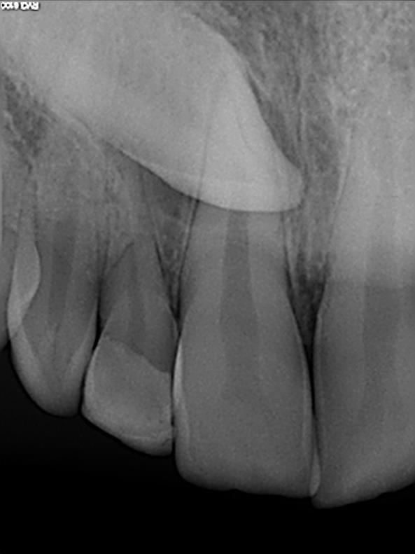 5. KIRURŠKO UKLANJANJE PREKOBROJINIH, IMPAKTIRANIH I RETINIRANIH ZUBA Impaktirani zubi su zubi koji nisu izniknuli zbog mehaničkih zapreka kao što su zbijenost u zubnom luku te prekobrojni zub u