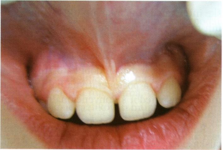 7. KIRURGIJA MEKIH TKIVA 7.1. Frenulektomija Labijalna frenulektomija kirurški je zahvat uklanjanja frenuluma (14). Frenulum je vezivnotkivni nabor koji povezuje usnu s alveolarnim grebenom.